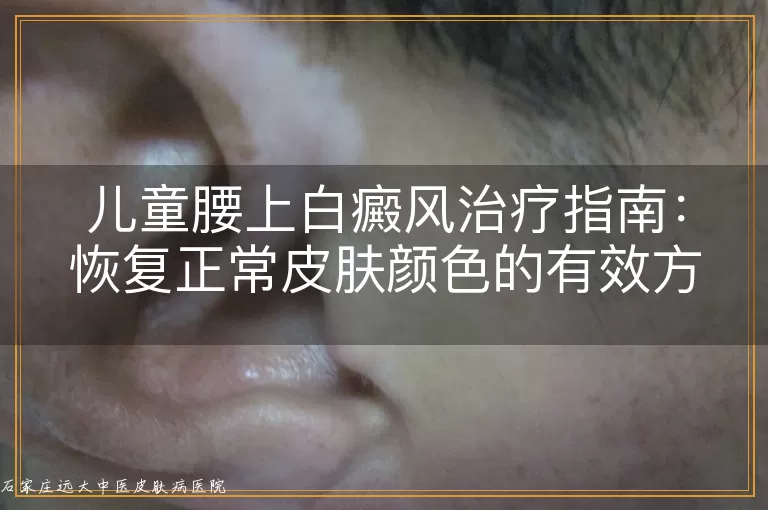 儿童腰上白癜风治疗指南:恢复正常皮肤颜色的有效方法