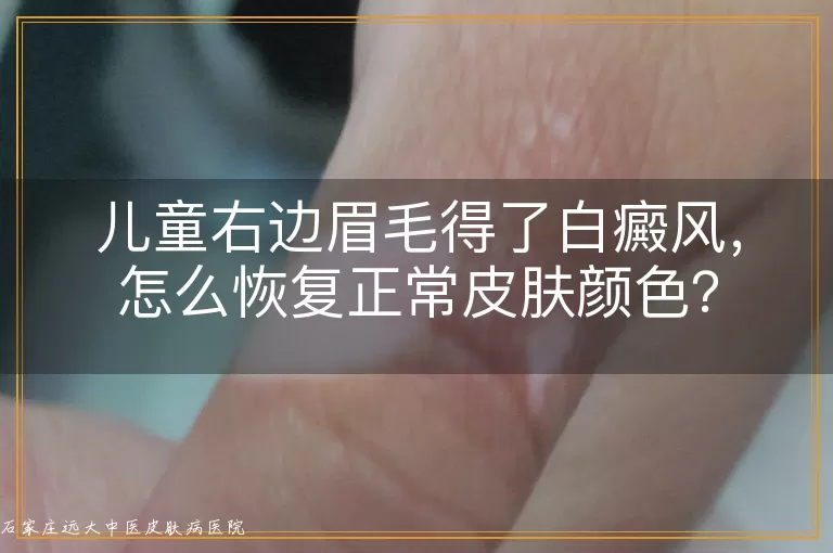 儿童右边眉毛得了白癜风，怎么恢复正常皮肤颜色？