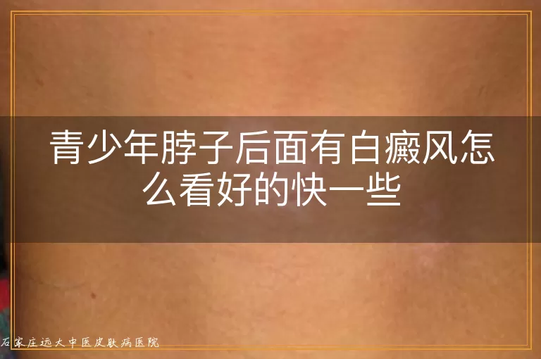 青少年脖子后面有白癜风怎么看好的快一些