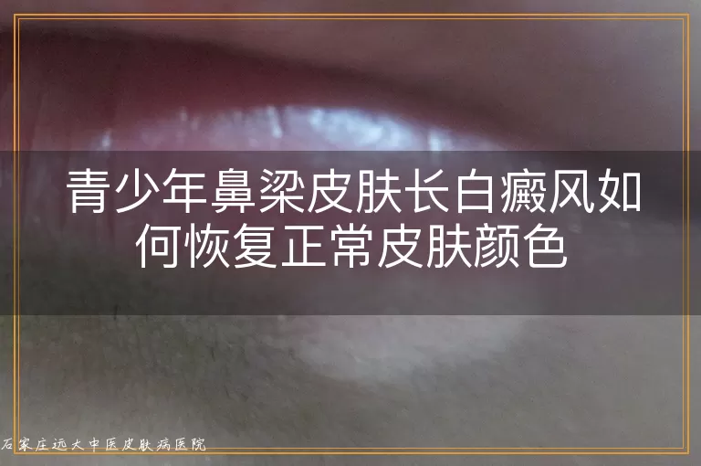 青少年鼻梁皮肤长白癜风如何恢复正常皮肤颜色