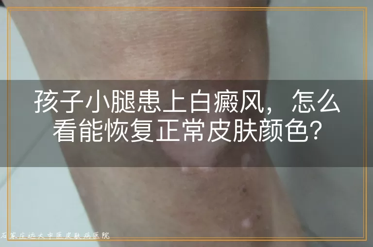 孩子小腿患上白癜风，怎么看能恢复正常皮肤颜色？