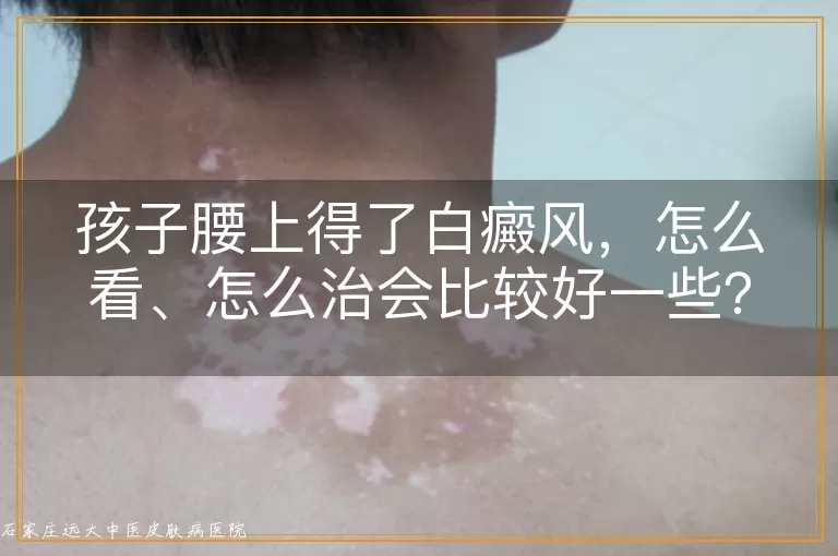 孩子腰上得了白癜风，怎么看、怎么治会比较好一些？
