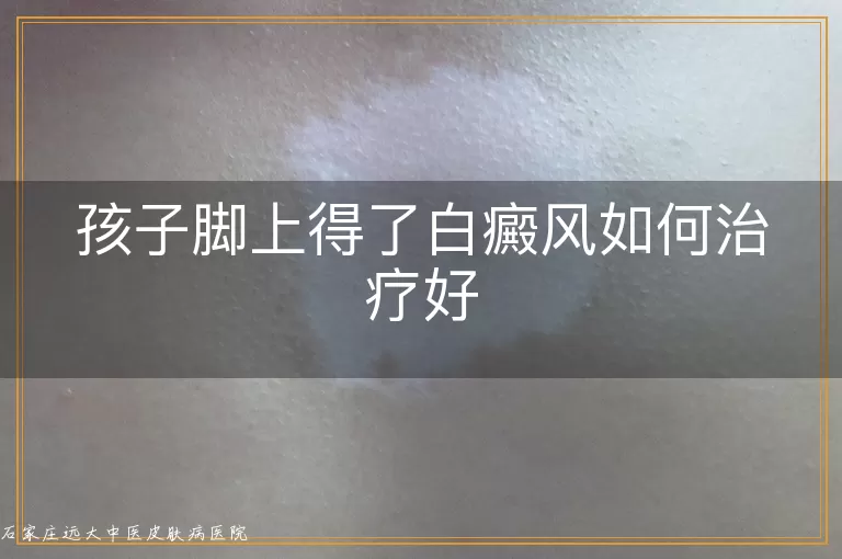 孩子脚上得了白癜风如何治疗好