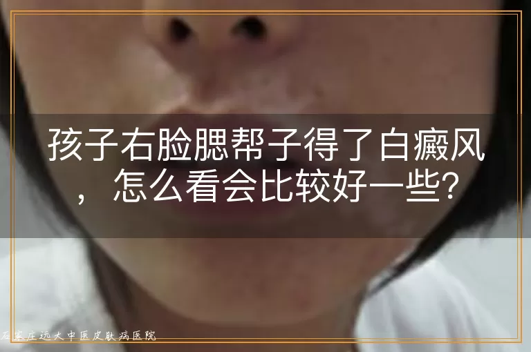 孩子右脸腮帮子得了白癜风，怎么看会比较好一些？