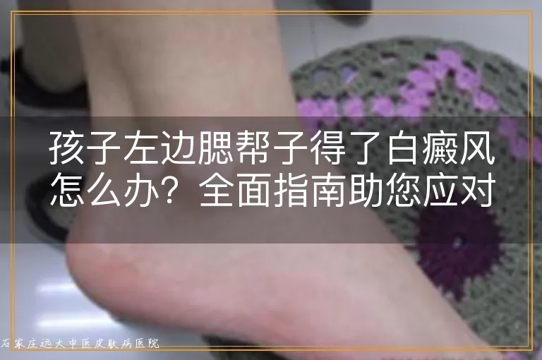 孩子左边腮帮子得了白癜风怎么办？全面指南助您应对