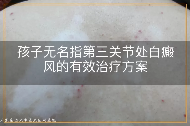 孩子无名指第三关节处白癜风的有效治疗方案