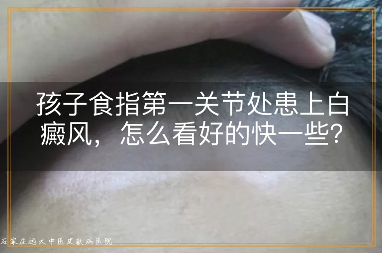 孩子食指第一关节处患上白癜风,怎么看好的快一些?