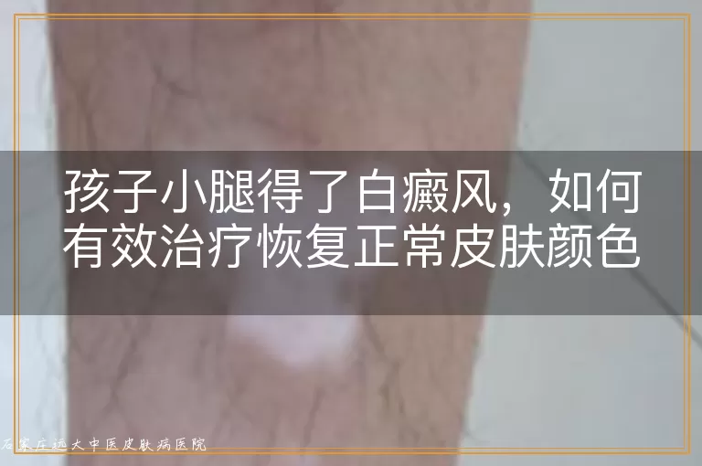 孩子小腿得了白癜风，如何有效治疗恢复正常皮肤颜色