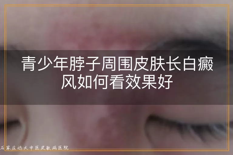 青少年脖子周围皮肤长白癜风如何看效果好