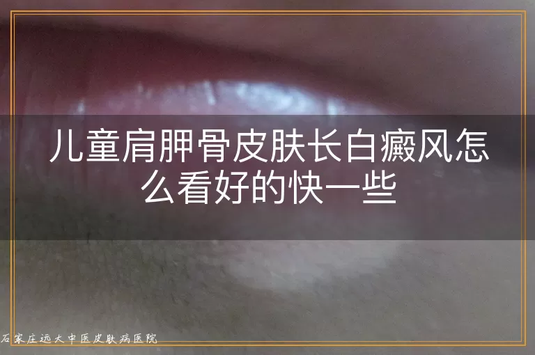 儿童肩胛骨皮肤长白癜风怎么看好的快一些