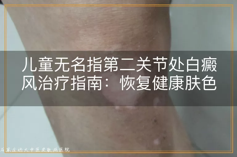 儿童无名指第二关节处白癜风治疗指南：恢复健康肤色的有效方法