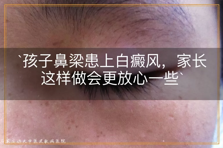 孩子鼻梁患上白癜风，家长这样做会更放心一些