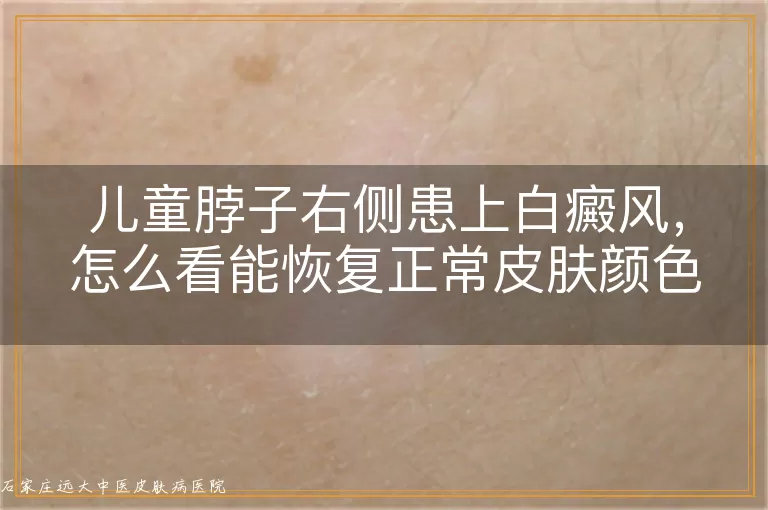 儿童脖子右侧患上白癜风,怎么看能恢复正常皮肤颜色?