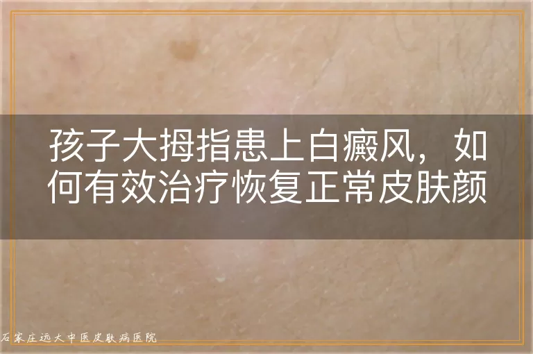 孩子大拇指患上白癜风，如何有效治疗恢复正常皮肤颜色