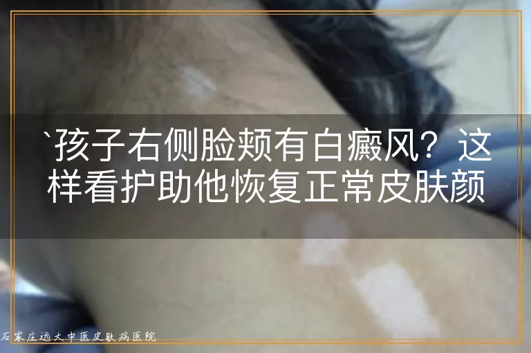 孩子右侧脸颊有白癜风？这样看护助他恢复正常皮肤颜色