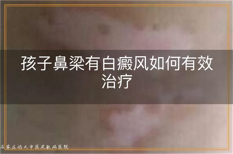 孩子鼻梁有白癜风如何有效治疗