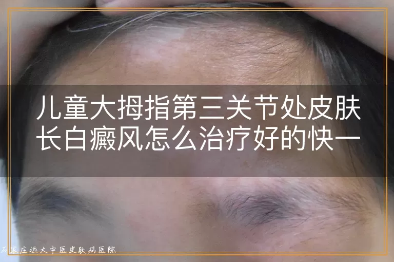 儿童大拇指第三关节处皮肤长白癜风怎么治疗好的快一些