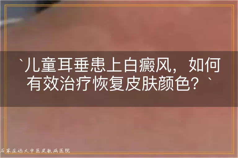 儿童耳垂患上白癜风，如何有效治疗恢复皮肤颜色？