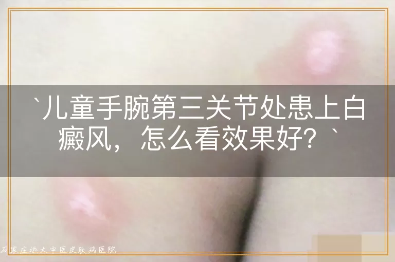 儿童手腕第三关节处患上白癜风,怎么看效果好?