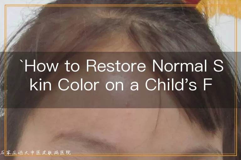 How to Restore Normal Skin Color on a Child's First Joint of the Index Finger Affected by Vitil