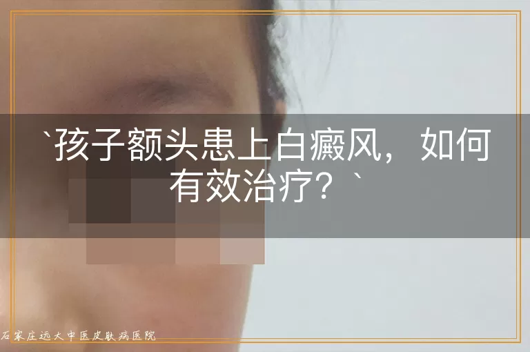 孩子额头患上白癜风，如何有效治疗？