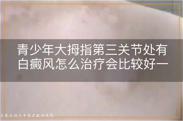 青少年大拇指第三关节处有白癜风怎么治疗会比较好一些