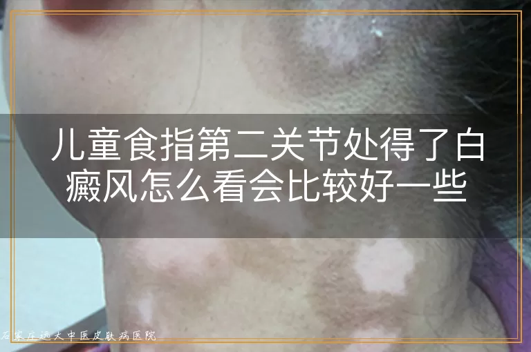 儿童食指第二关节处得了白癜风怎么看会比较好一些