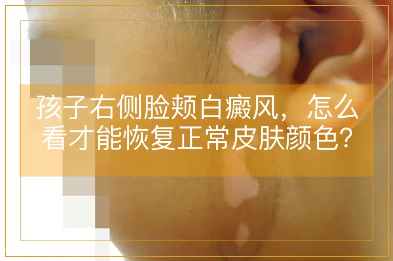 孩子右侧脸颊白癜风，怎么看才能恢复正常皮肤颜色？