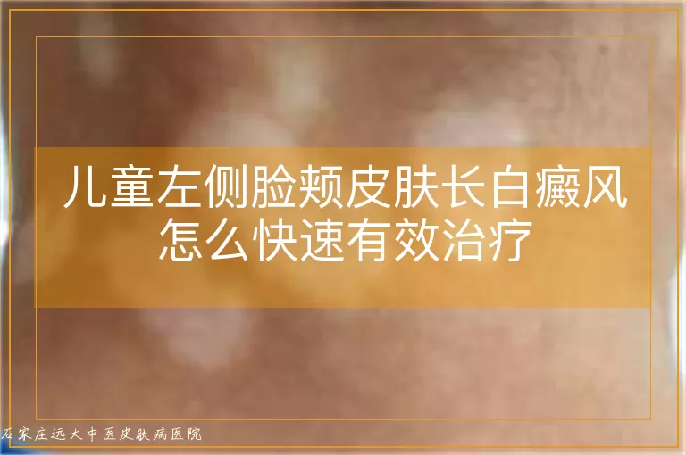 儿童左侧脸颊皮肤长白癜风怎么快速有效治疗