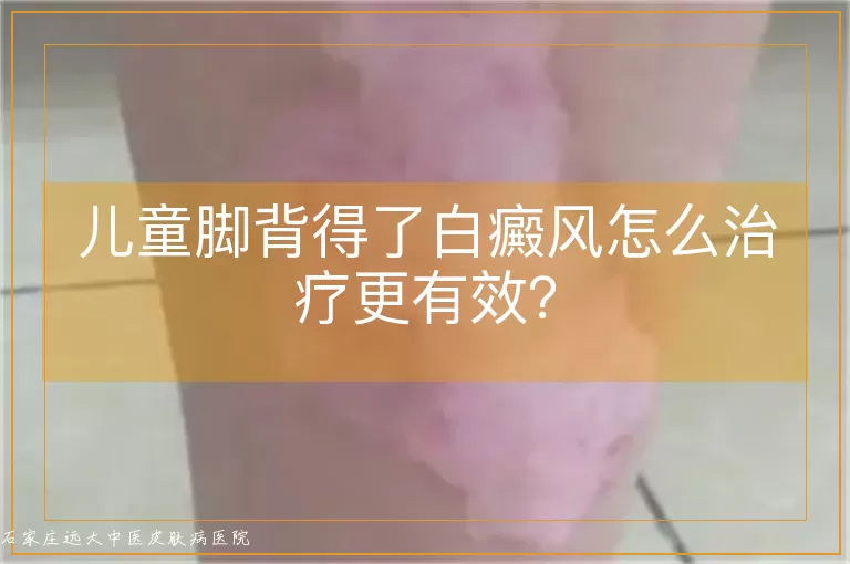 儿童脚背得了白癜风怎么治疗更有效?