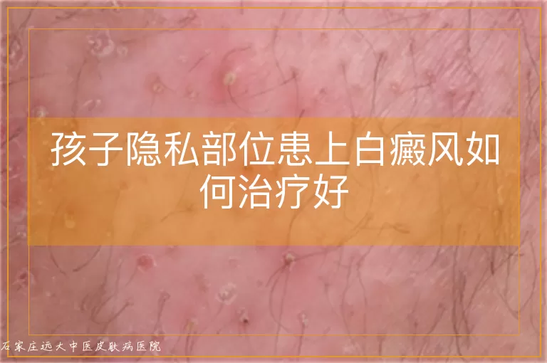 孩子隐私部位患上白癜风如何治疗好