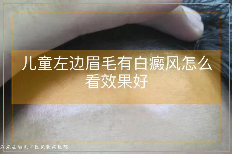 儿童左边眉毛有白癜风怎么看效果好