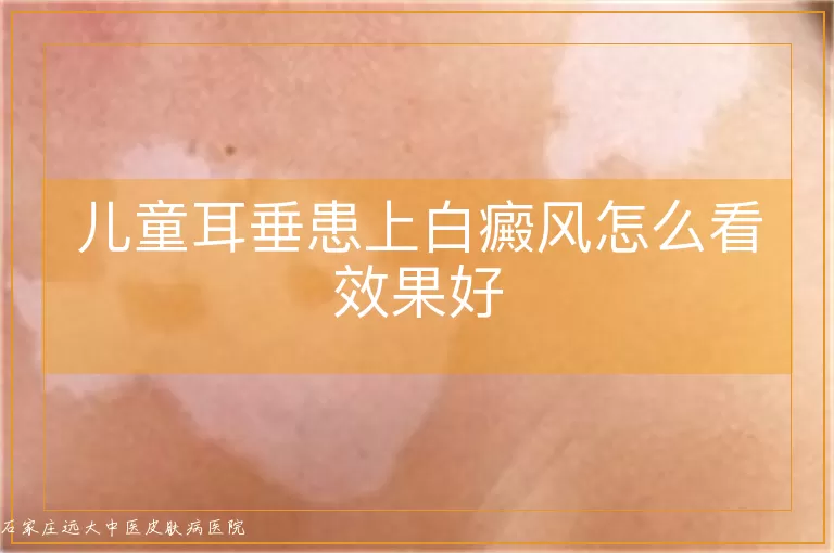 儿童耳垂患上白癜风怎么看效果好