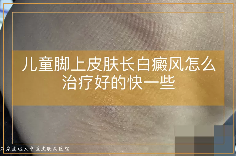 儿童脚上皮肤长白癜风怎么治疗好的快一些