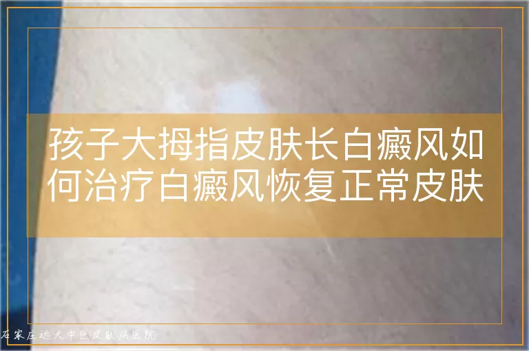 孩子大拇指皮肤长白癜风如何治疗白癜风恢复正常皮肤颜色