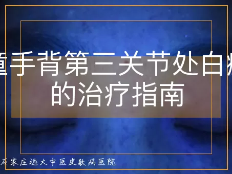 儿童手背第三关节处白癜风的治疗指南