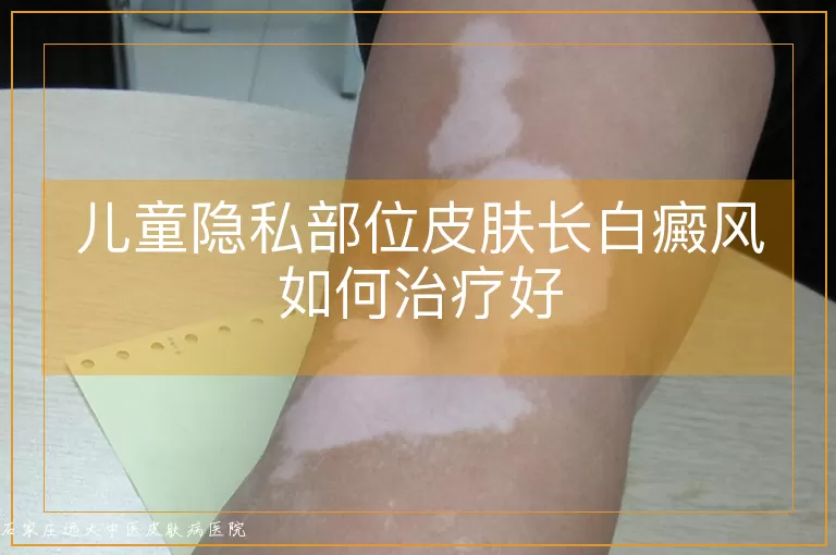 儿童隐私部位皮肤长白癜风如何治疗好