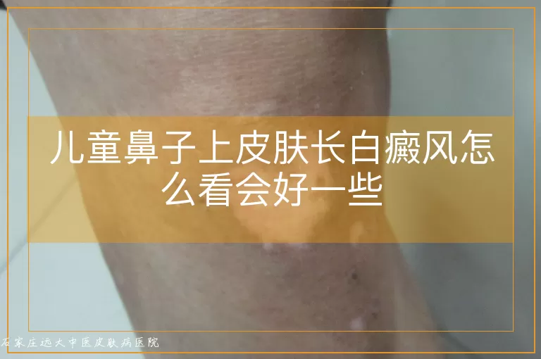 儿童鼻子上皮肤长白癜风怎么看会好一些