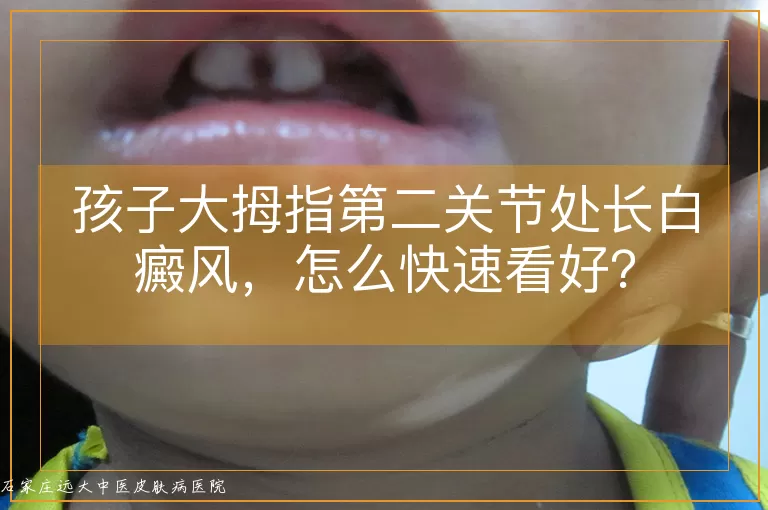 孩子大拇指第二关节处长白癜风，怎么快速看好？