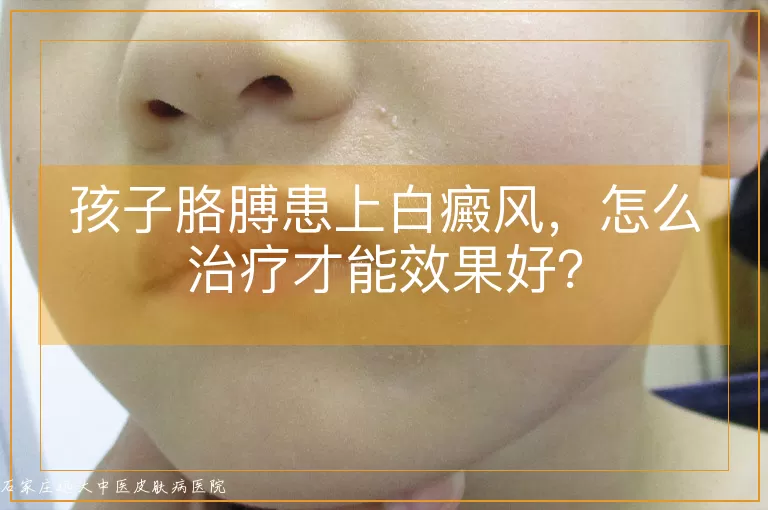 孩子胳膊患上白癜风，怎么治疗才能效果好？