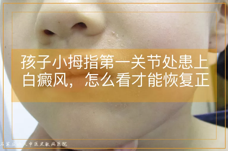 孩子小拇指第一关节处患上白癜风，怎么看才能恢复正常皮肤颜色？