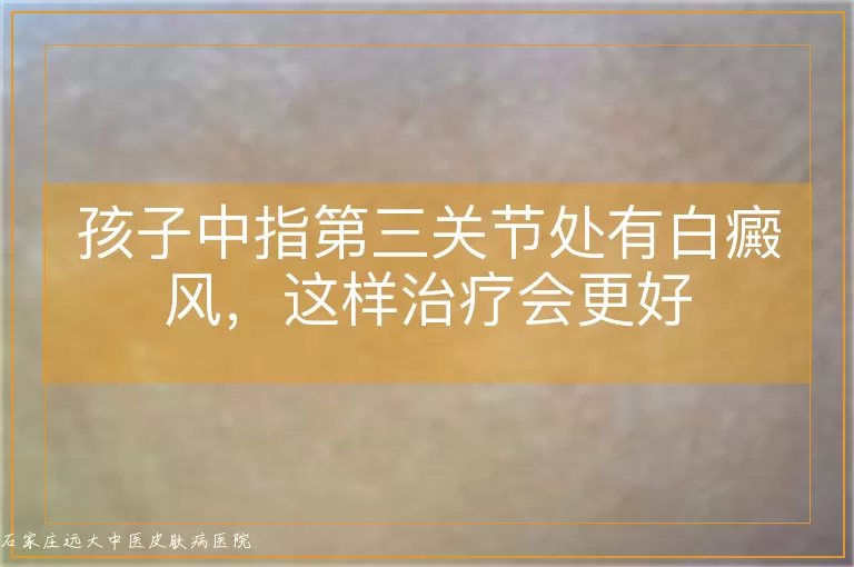 孩子中指第三关节处有白癜风，这样治疗会更好