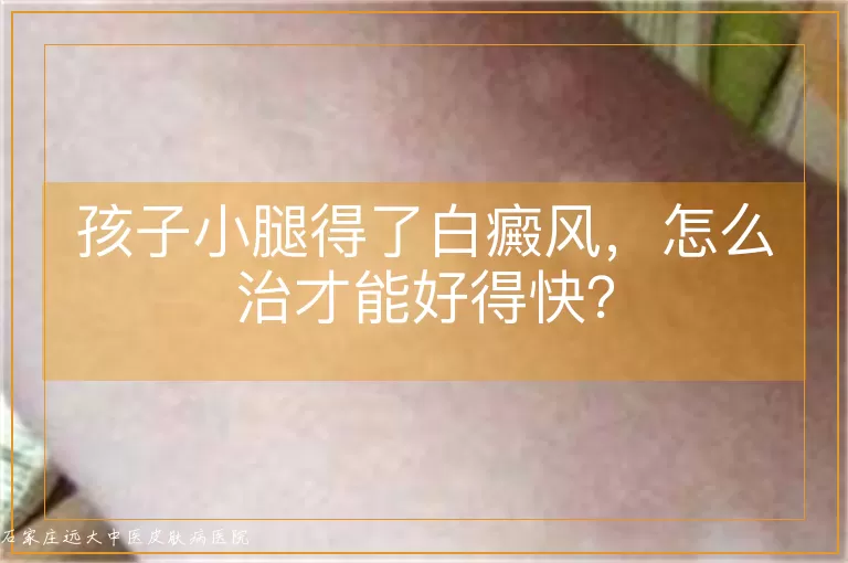 孩子小腿得了白癜风，怎么治才能好得快？