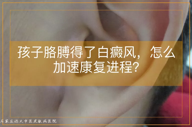 孩子胳膊得了白癜风，怎么加速康复进程？