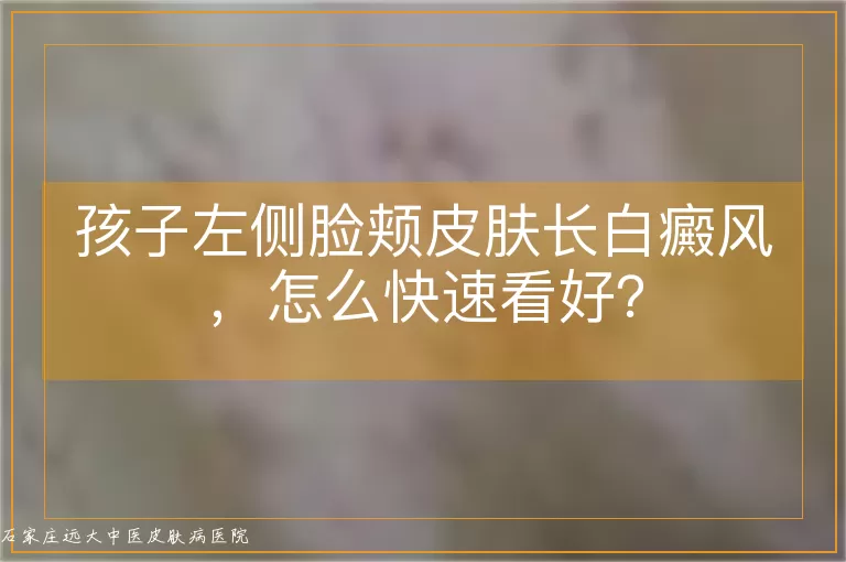 孩子左侧脸颊皮肤长白癜风，怎么快速看好？