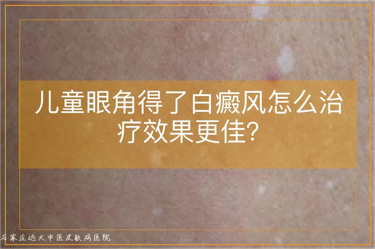 儿童眼角得了白癜风怎么治疗效果更佳?