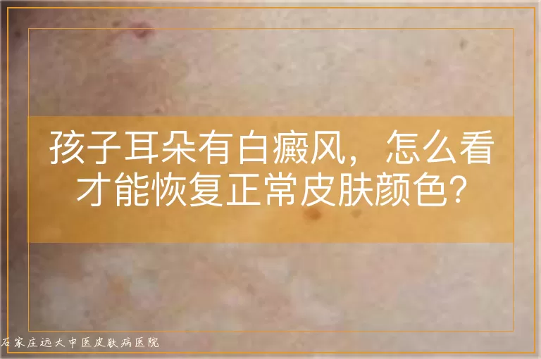孩子耳朵有白癜风，怎么看才能恢复正常皮肤颜色？