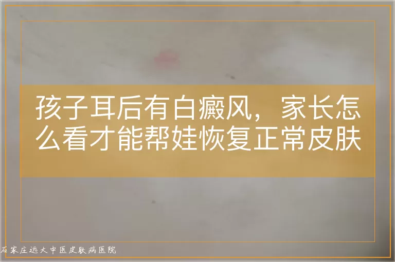 孩子耳后有白癜风，家长怎么看才能帮娃恢复正常皮肤颜色？