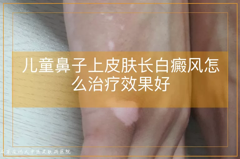 儿童鼻子上皮肤长白癜风怎么治疗效果好