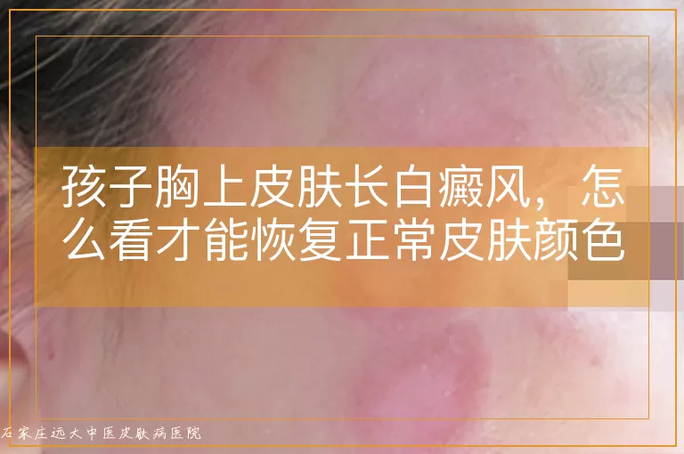 孩子胸上皮肤长白癜风，怎么看才能恢复正常皮肤颜色？